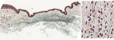 Discovery of why sunburn hurts could lead to new pain relief for inflammatory conditions Discovery of why sunburn hurts could lead to new pain relief for inflammatory conditions