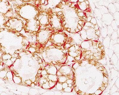 How breast cancer usurps the powers of mammary stem cells How breast cancer usurps the powers of mammary stem cells