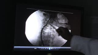 Stents and surgery for blocked neck arteries are  neck-and-neck as lasting stroke prevention