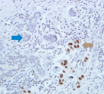 High levels of master heat shock protein linked to poor prognosis in breast cancer patients High levels of master heat shock protein linked to poor prognosis in breast cancer patients