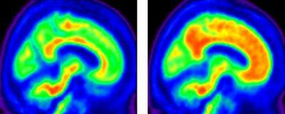 Study of Alzheimer's-related protein in healthy adults may shed light on earliest signs of disease Study of Alzheimer's-related protein in healthy adults may shed light on earliest signs of disease