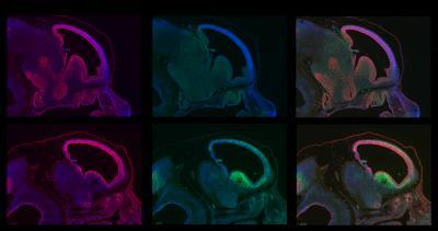 Scientists reveal potential link between brain development and breast cancer gene Scientists reveal potential link between brain development and breast cancer gene