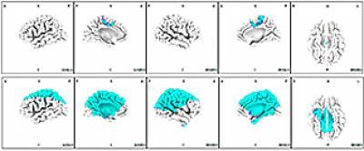 In schizophrenia patients, auditory cues sound bigger problems In schizophrenia patients, auditory cues sound bigger problems