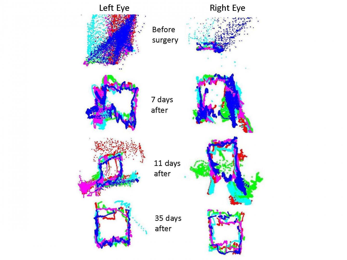 New technology advances eye tracking as biomarker for brain function and brain injury New technology advances eye tracking as biomarker for brain function and brain injury