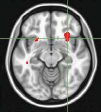 Scan predicts whether therapy or meds will best lift depression Scan predicts whether therapy or meds will best lift depression