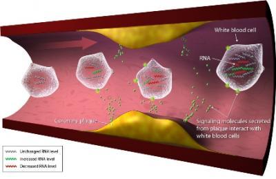 Blood-based genomic test better than imaging test for ruling out obstructive coronary artery disease