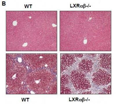 UCLA study finds cholesterol regulator plays key role in development of liver scarring, cirrhosis