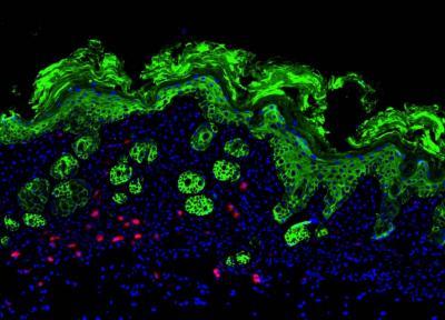 Itching for new help for eczema: Recently identified immune cells possible therapeutic target Itching for new help for eczema: Recently identified immune cells possible therapeutic target