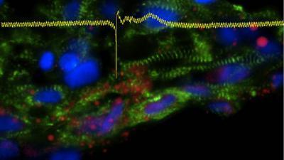 Patients' own skin cells are transformed into heart cells  to create 'disease in a dish'