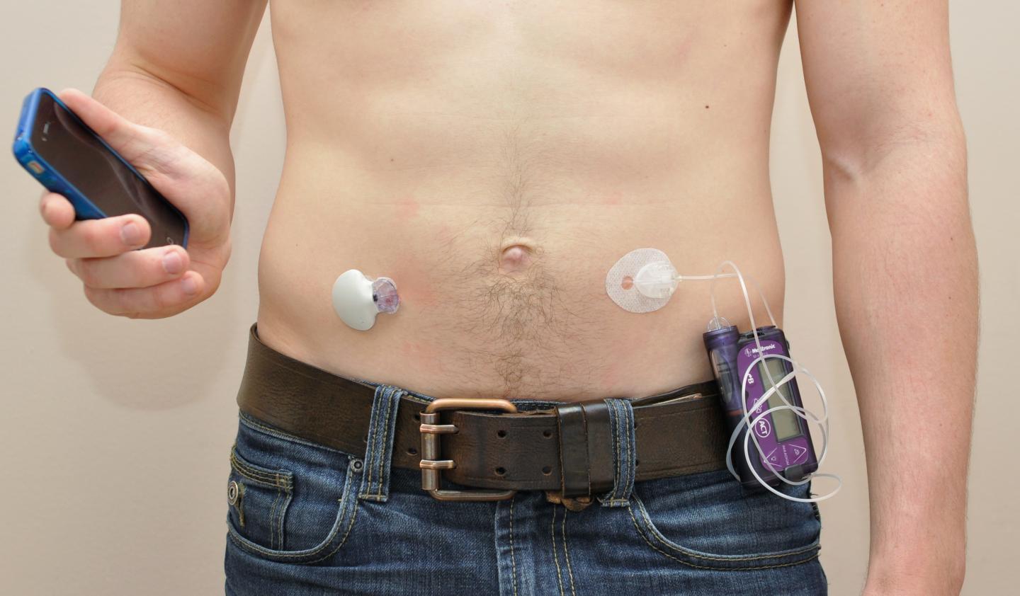 The artificial pancreas shown to improve the treatment of type 1 diabetes Science Codex